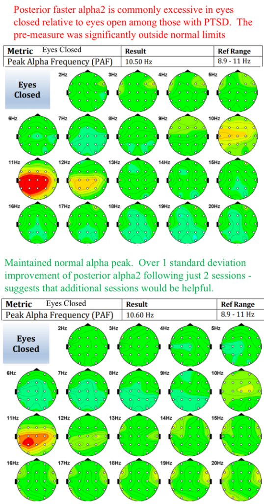 qEEG from Evoke Neuroscience Evox.